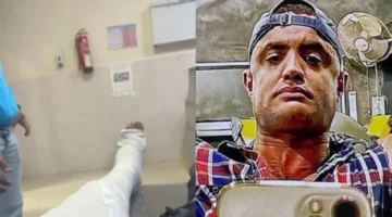 جراحة عاجلة.. شريحة و9 مسامير تنقذ بطل كمال الأجسام في مسلسل الكينج